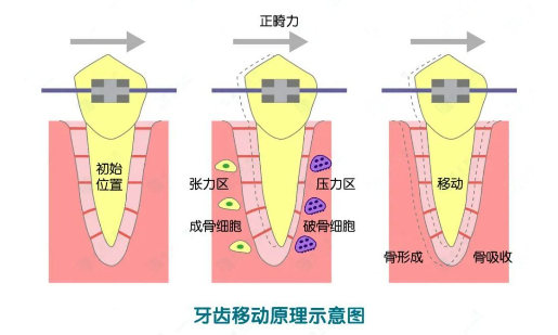 具体步骤如下:1,制定矫正方案主要有隐形矫正,陶瓷托槽矫治器,钢丝