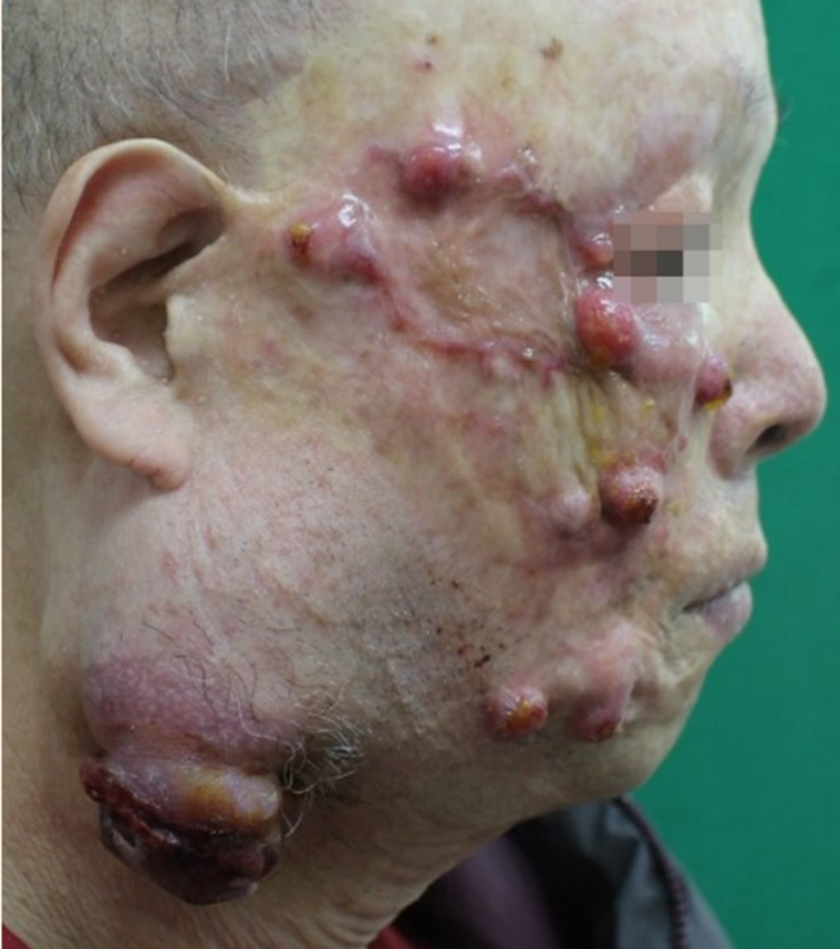 热烧伤疤痕上的恶性黑色素瘤 身材总监烧烫伤压力衣定制 - 知乎