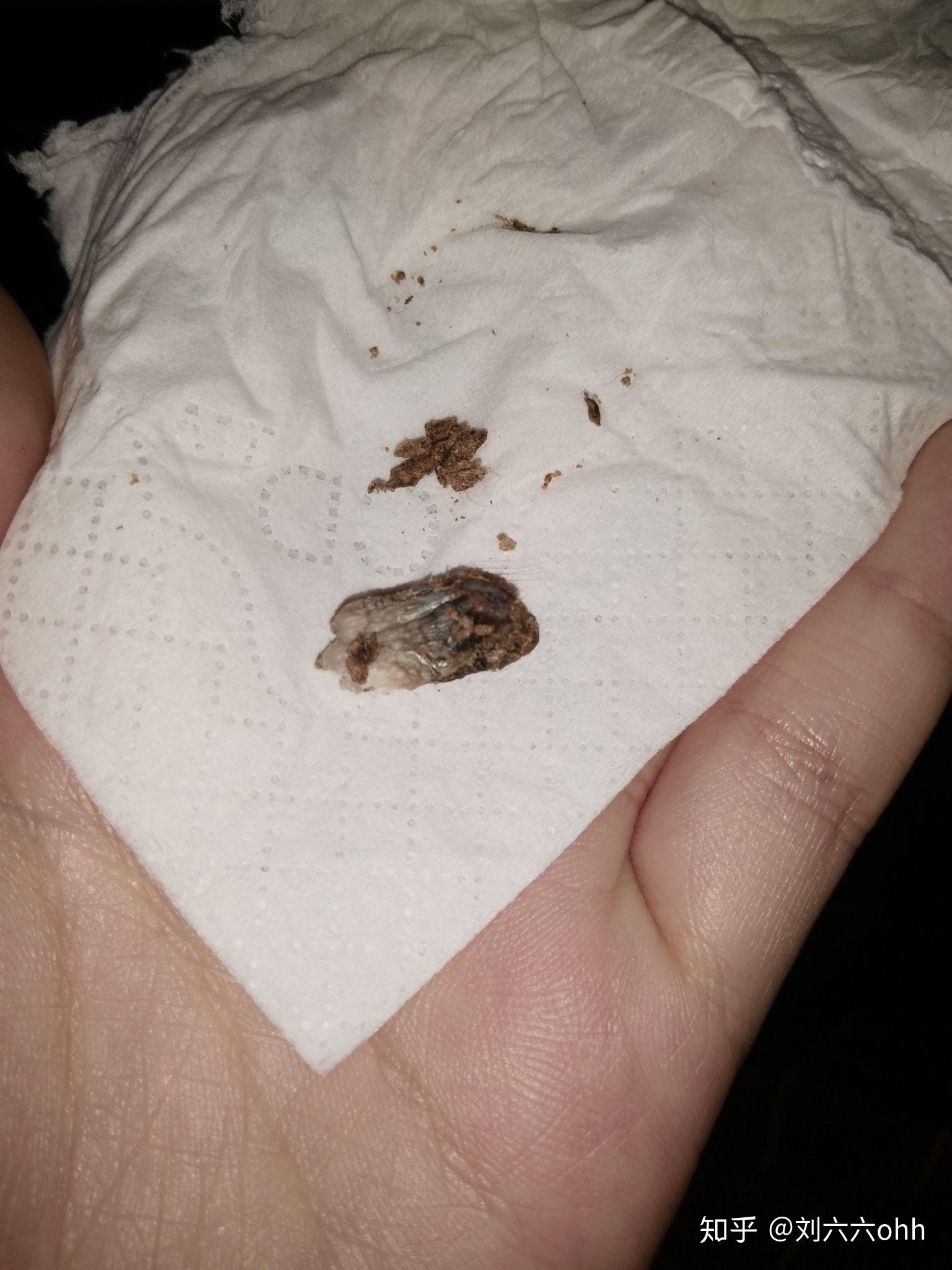 肚脐眼里面的灰可以抠吗抠了肚子会进风人会生病之类的说法正确吗是否