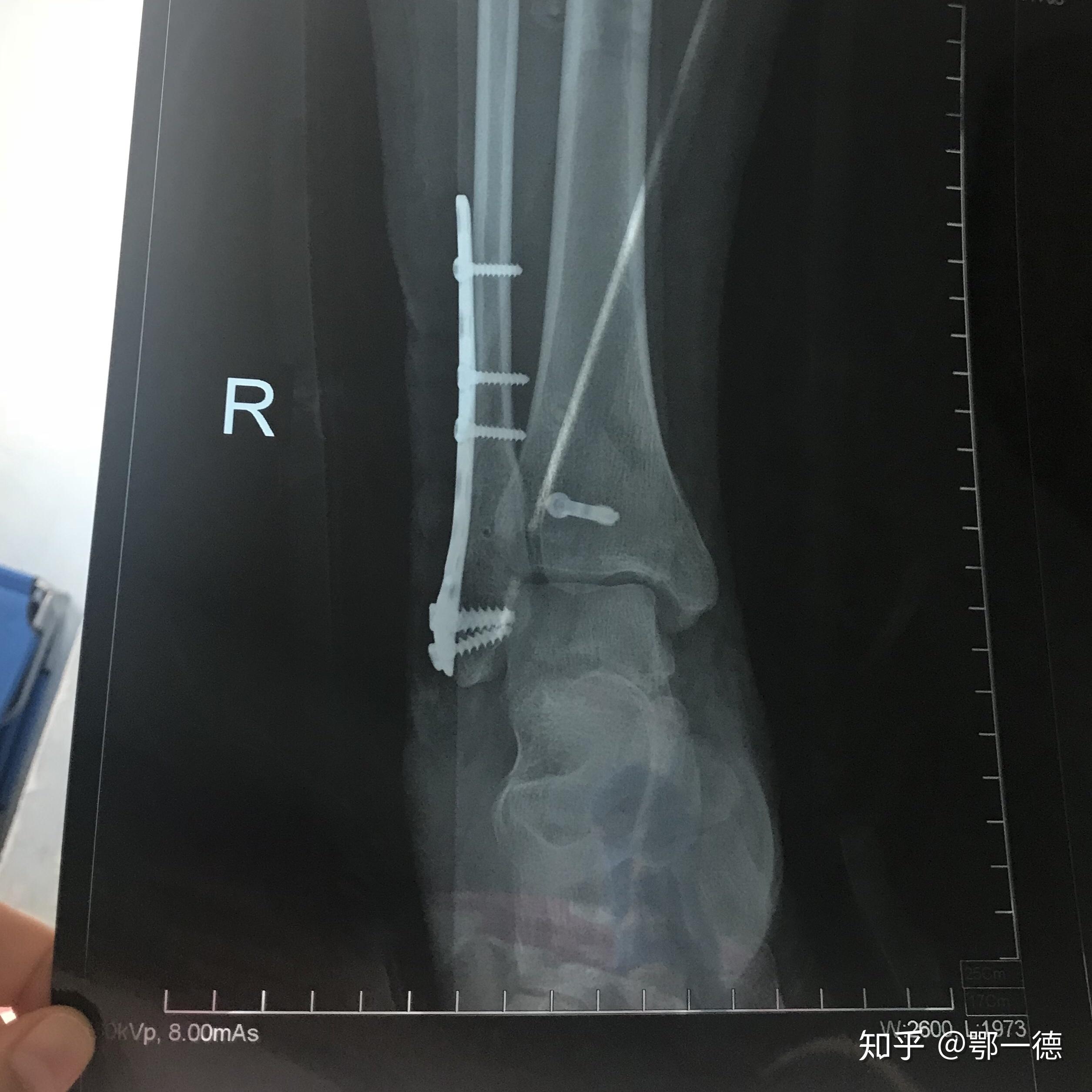 三周前，我从高处跳下，伤到了脚踝，请大家帮我看看X光片，看是哪里骨折了？需怎么治疗？_百度知道
