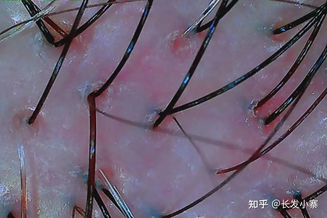 长发小寨-头皮类型自检攻略，从头皮颜色判断头皮情况！ - 知乎