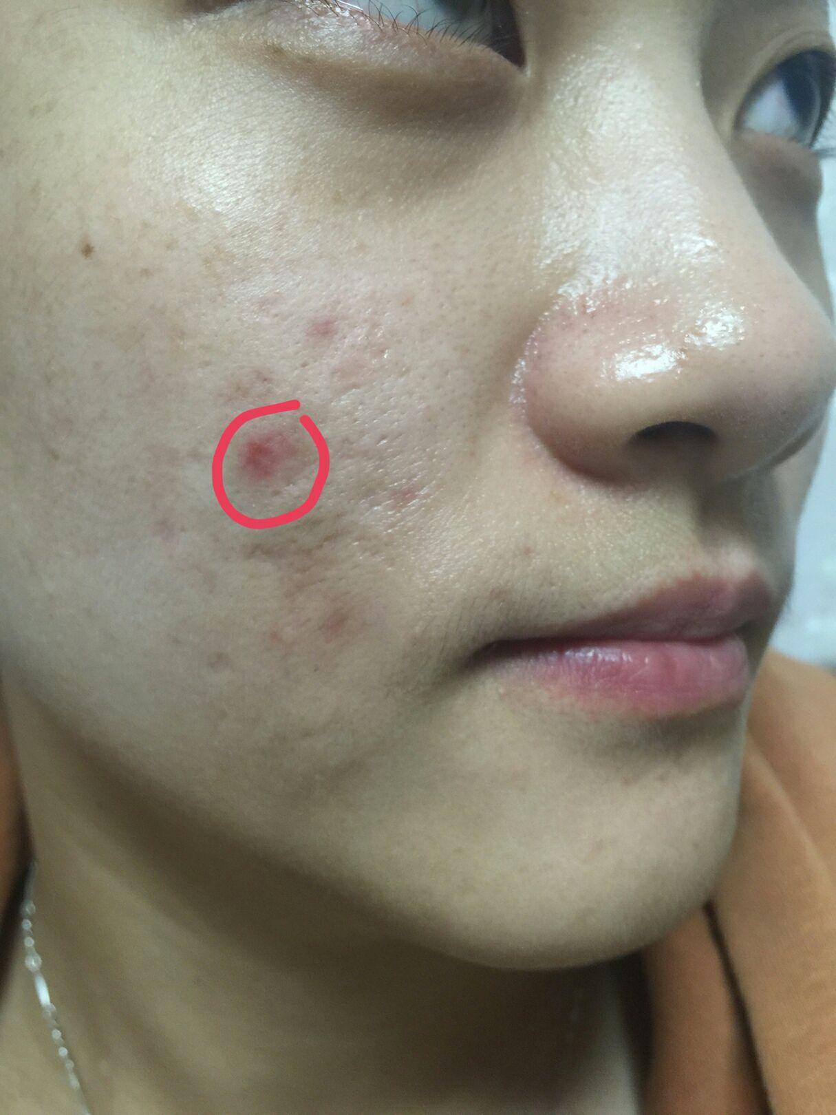 皮膚科王修含醫師: 蟹足腫與肥厚性疤痕是怎麼發生的？