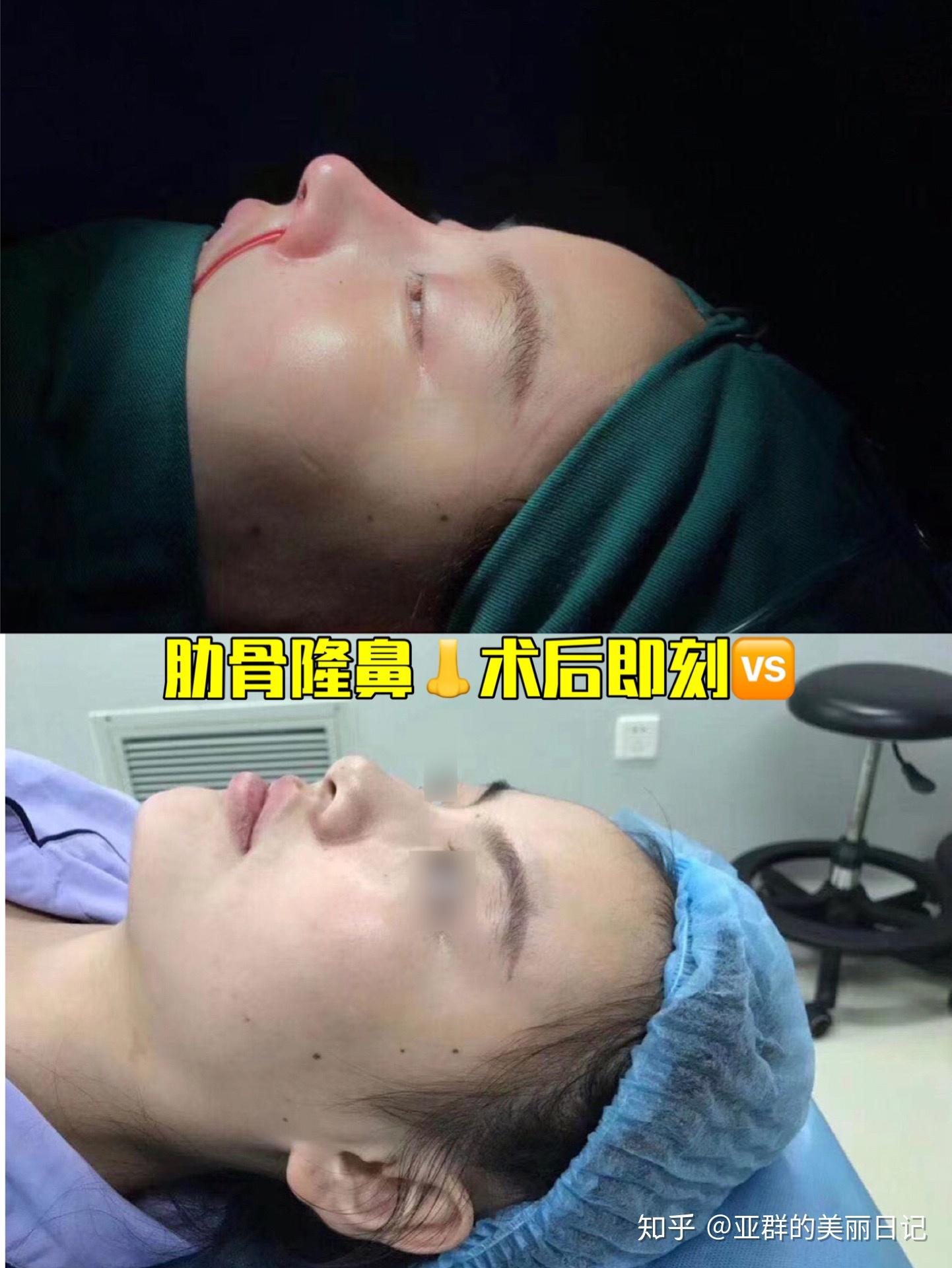 肋骨隆鼻术前认知很重要