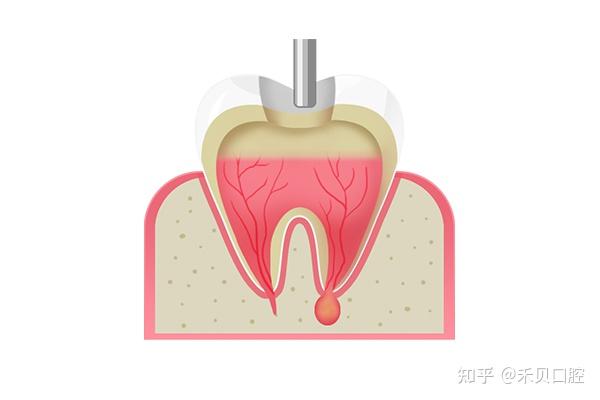 根尖诱导成形术是什么? - 知乎