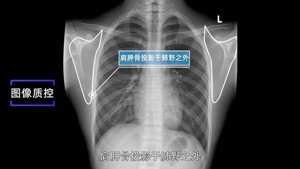 肩胛骨x光片正侧位图片