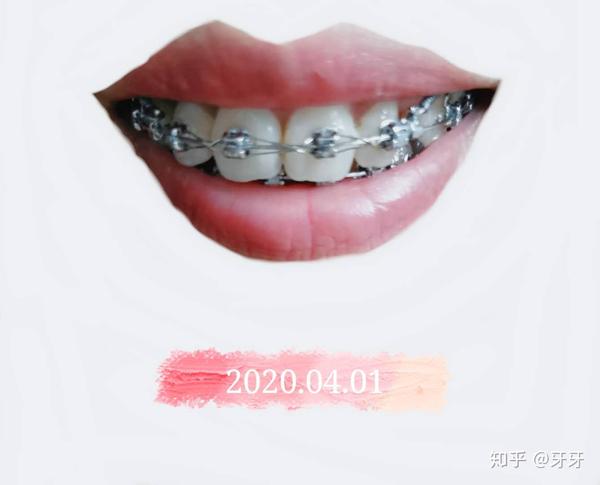 完结啦~~28岁拔牙打骨钉正畸,舌侧丝保持器记录贴,详尽的整牙手册 - 知乎