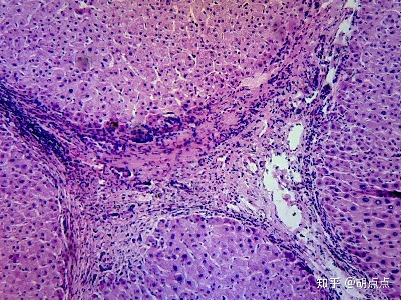 急性C型肝炎の症状は何ですか?