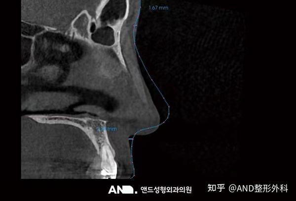 打造吴妍书鼻子般自然、高、细滑的鼻部线条[通过3D打印的艺人鼻部整形]:鼻部再手术（鼻梁整形+鼻尖整形+人中鼻+龙鼻+功能鼻+鼻翼缩小）前后 ...