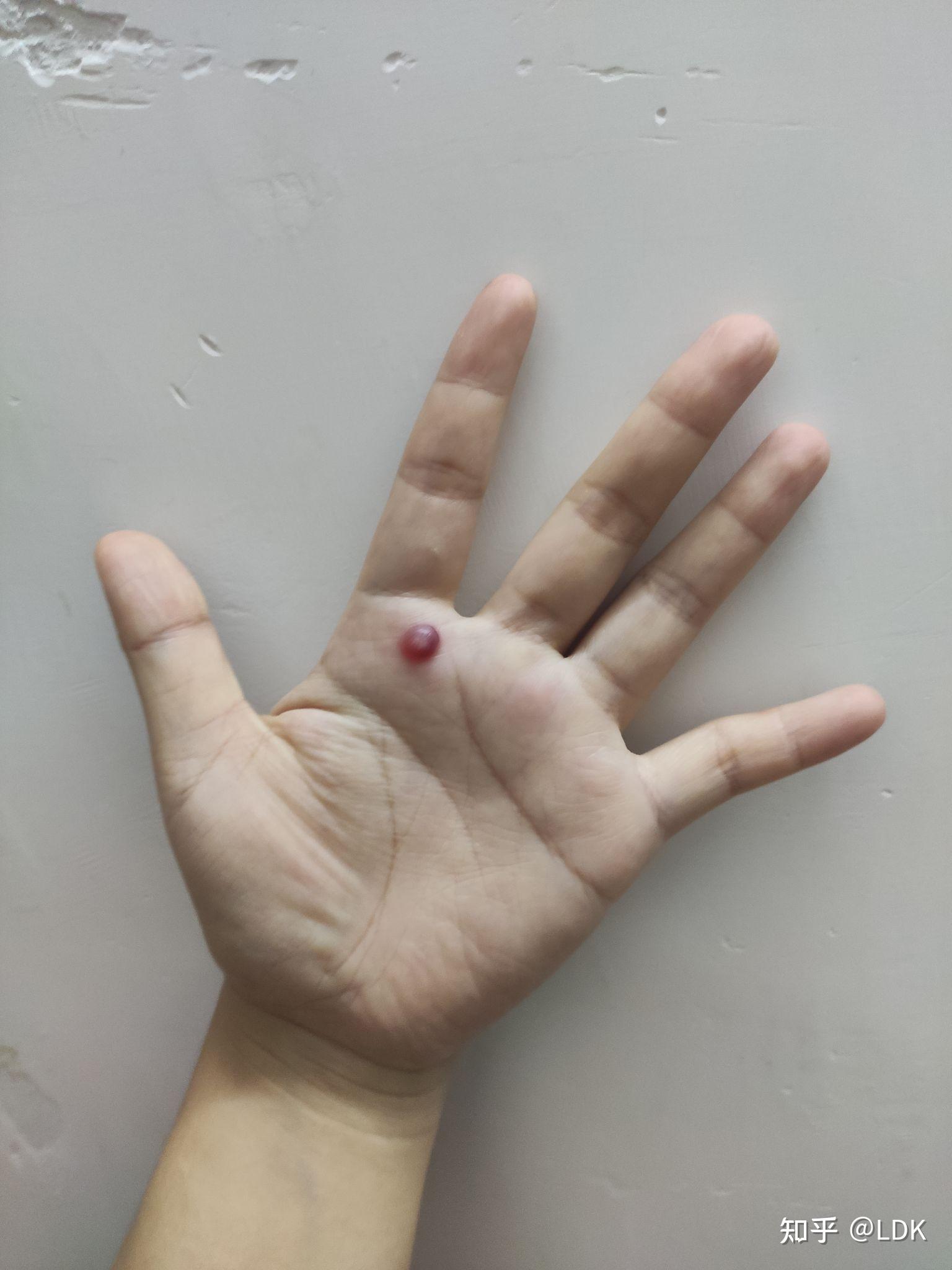 液氮冷冻治疗寻常疣