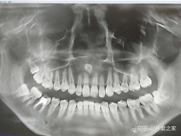但有少部分的多生牙会选择"潜伏"在颌骨内不萌出,甚至野蛮地倒着长
