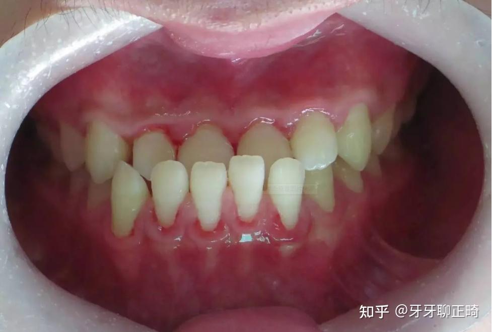 地包天怎么办?要正畸还是正颌? - 知乎