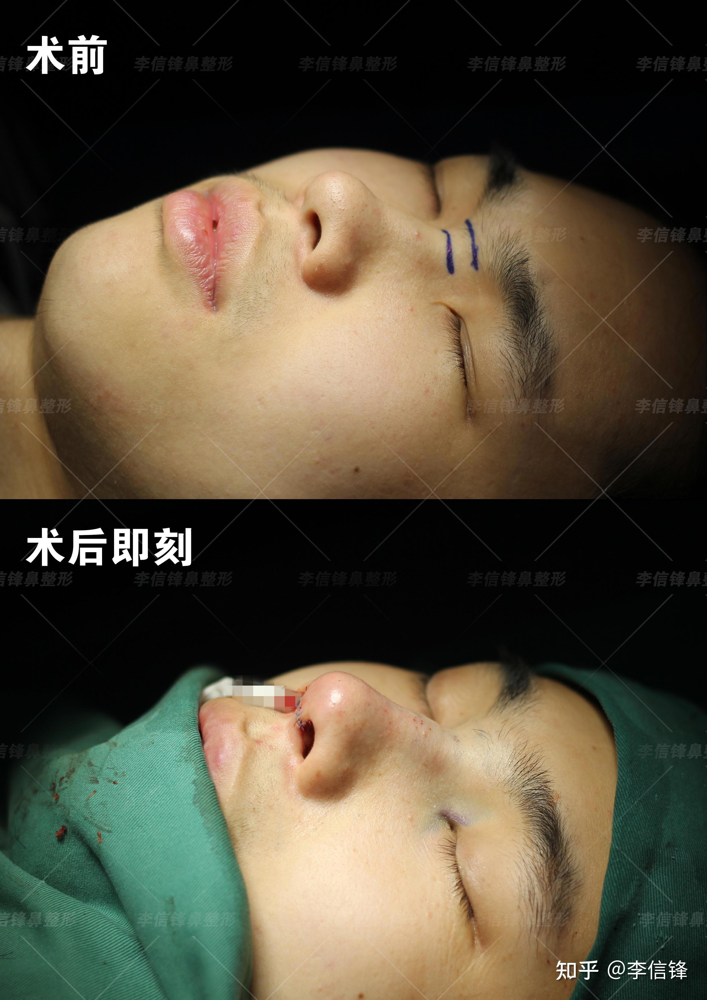 初鼻-男生隆鼻案例,面中部凹陷,嘴凸改善,术后即刻~深圳李信锋隆鼻