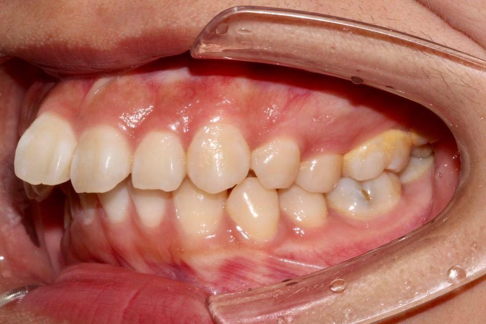 检查:安氏iii类,骨性i类,凸面型,低角,深覆盖iii度,深覆颌ii度,牙弓尖