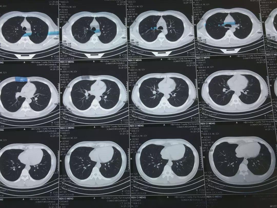 胸片 or CT?应该怎么选择?有什么差别 - 知乎