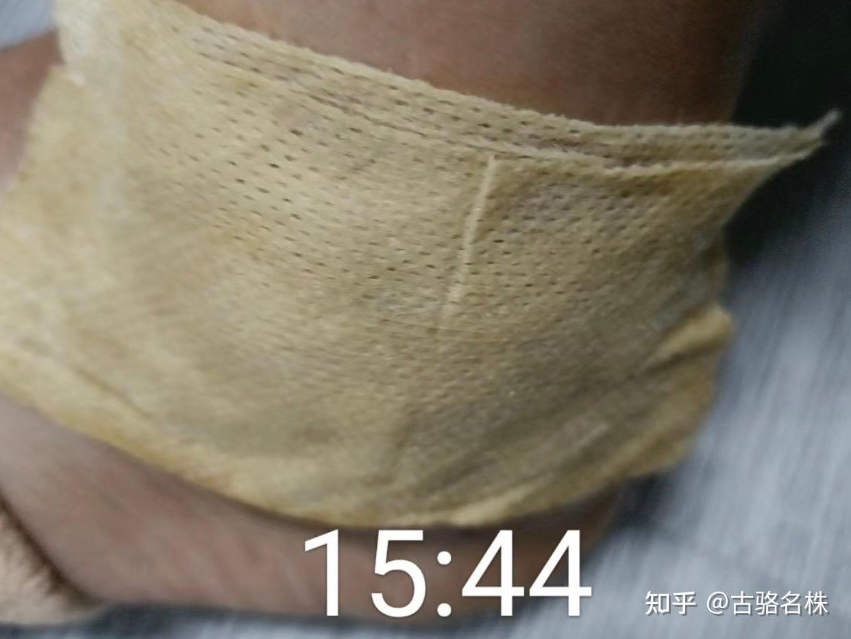 案例篇|跌打损伤 - 知乎
