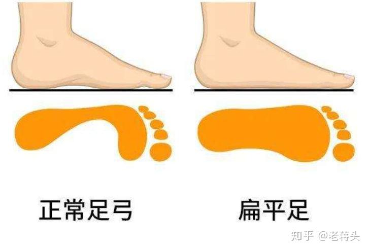 拇外翻、拇囊炎、大脚趾不灵活，是为什么呢？怎么解决？ - 知乎