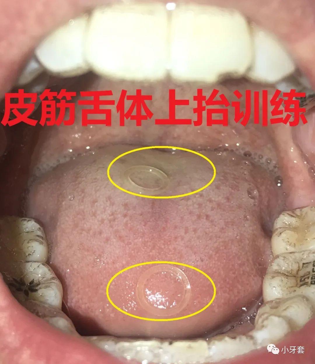 改善下巴後縮嘴凸的口周肌肉鍛鍊動作帶練習視頻