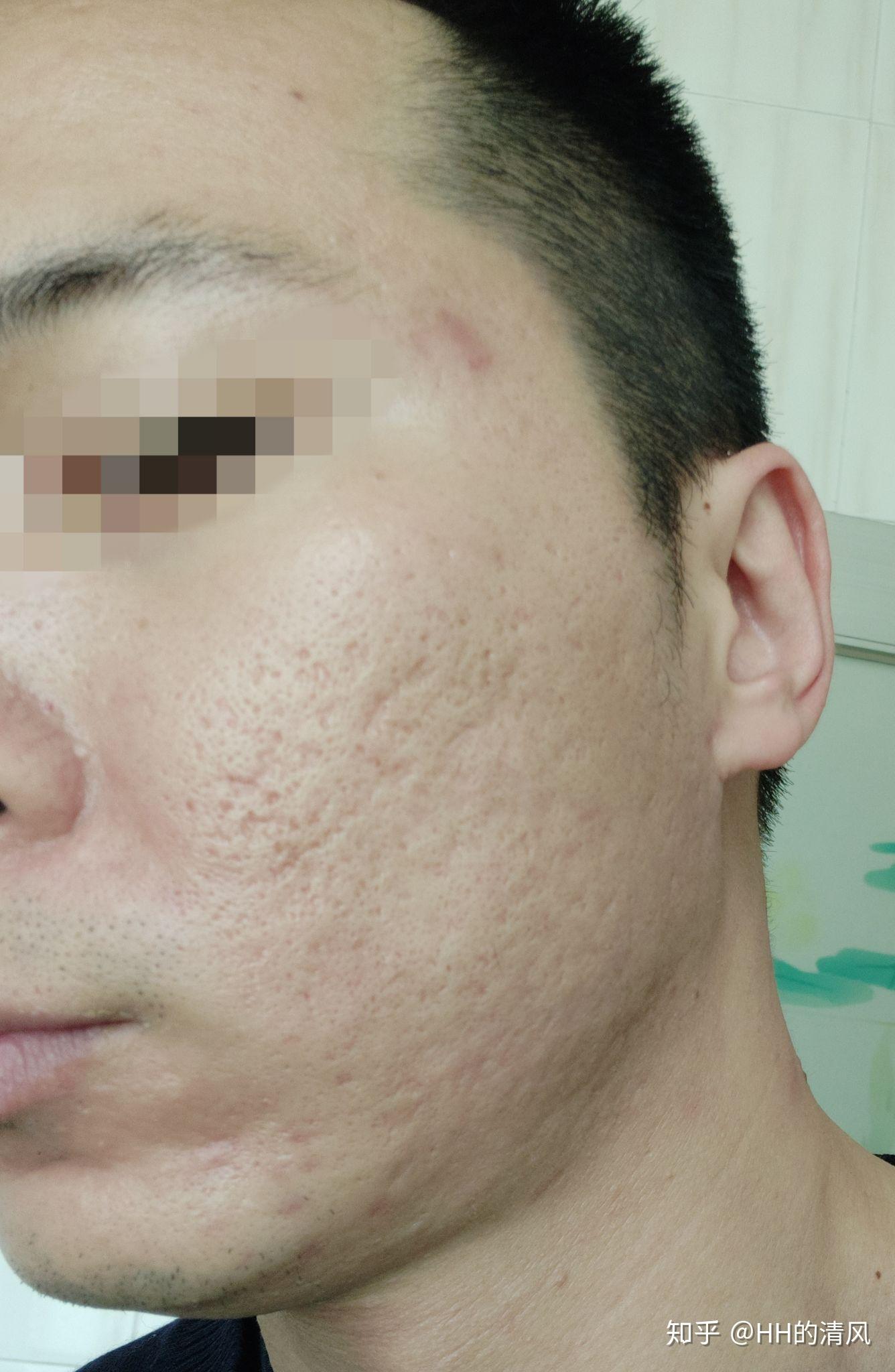 6月24日更新第二次记录剥脱性点阵激光祛痘坑3月8日做了第一次