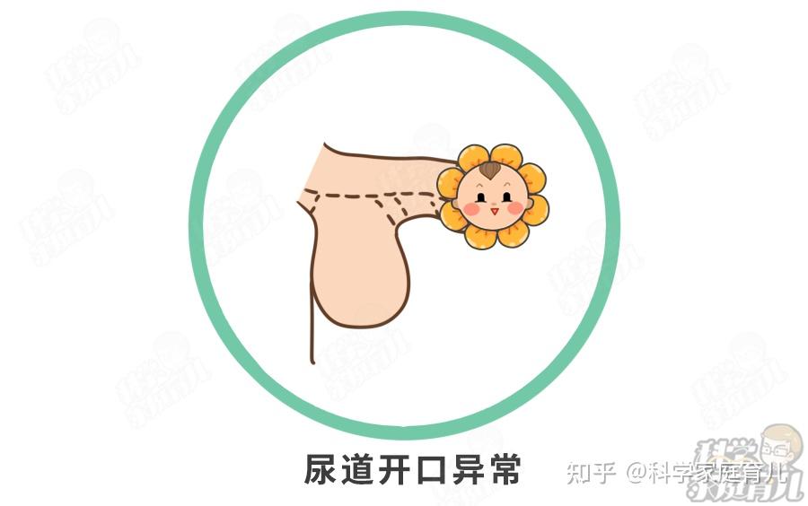 74尿道开口异常图片来源:科学家庭育儿原创74阴茎下弯但是!