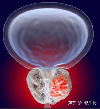 前列腺癌创新疗法诺华PSMA靶向放射配体疗法Pluvicto在美国获批显著延长患者生存 知乎