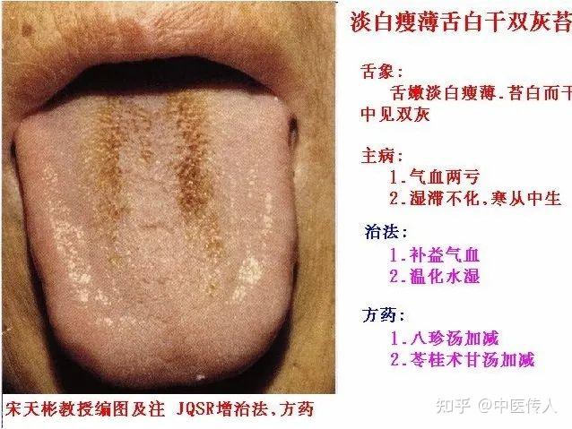 高清舌诊图解:各种临床证型舌象图谱大开眼界 - 知乎