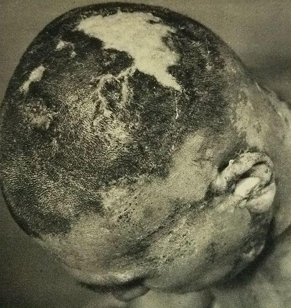 1954年4月7日,第五福龙丸船员的头皮因为电离辐射而受伤脱色.