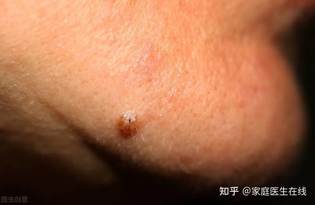 身上的痣突然发痒,可能是癌变的表现!若出现这6种情况,要警惕 - 知乎