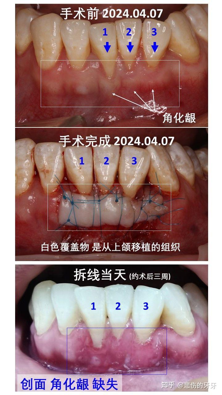 膜龈手术图片