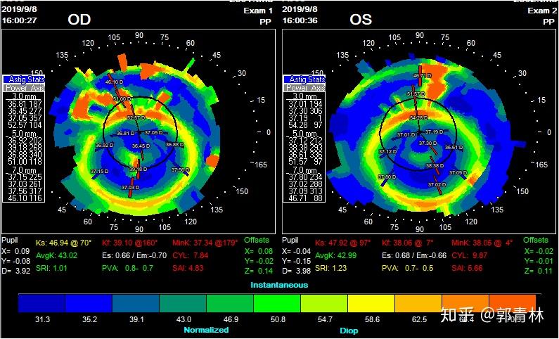25,角膜中央片样点染,且伴有浸润,角膜地形图如下:从地形图来看,双