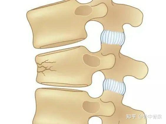 老年人摔倒后腰部反复疼痛要当心胸腰椎骨质疏松性骨折
