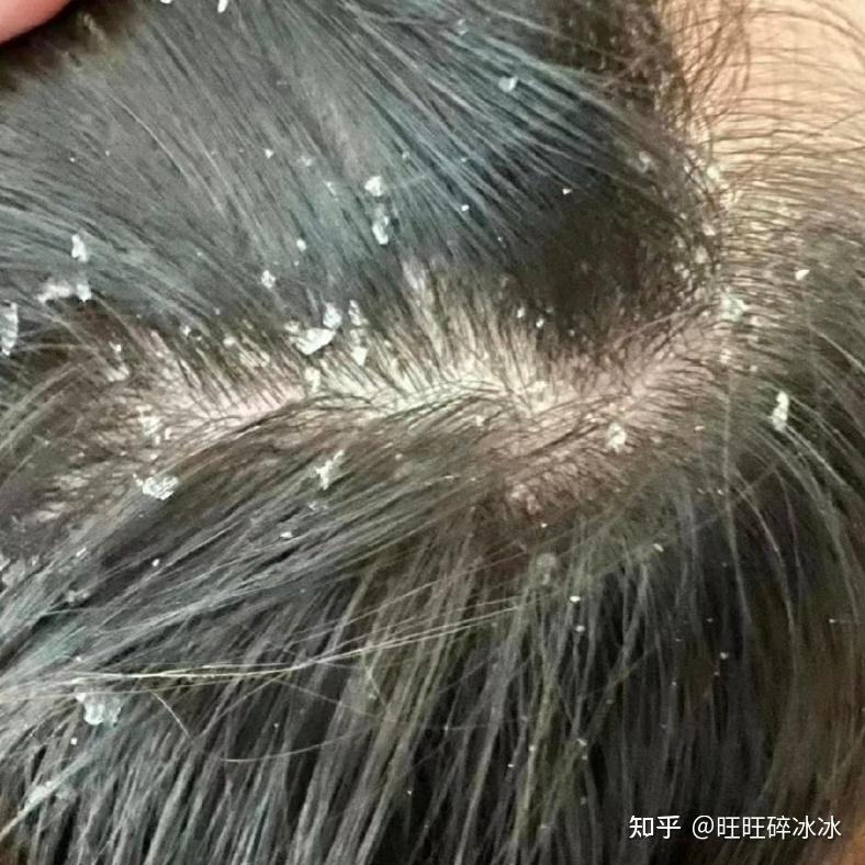 学医5年告诉你,头皮屑多、洗不干净到底该怎么解决? - 知乎