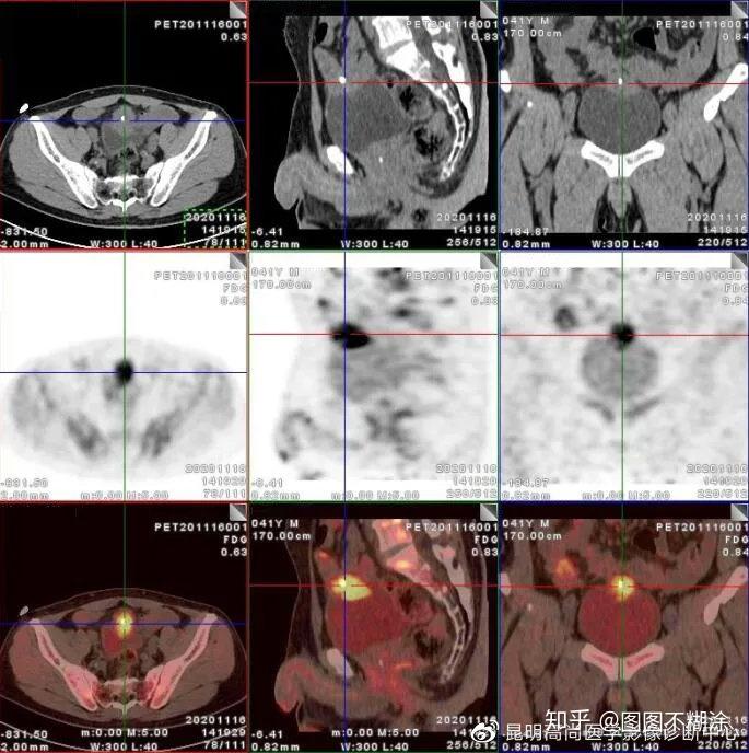 罕见病例临床少见的脐尿管癌