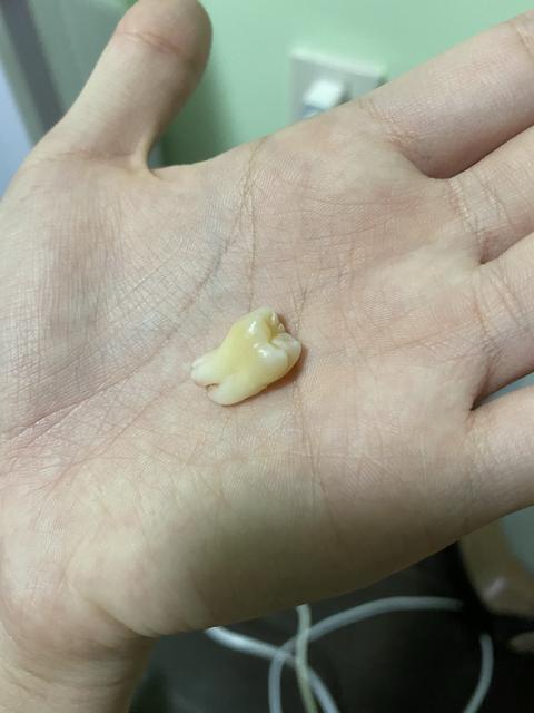 智齿牙胚图片