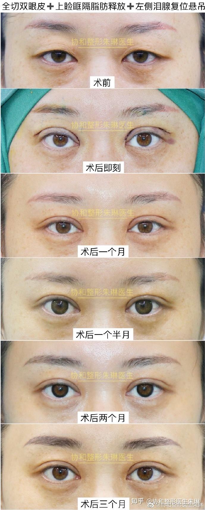 今日案例，全切双眼皮 上睑眶隔脂肪释放 左侧泪腺复位悬吊。 - 知乎