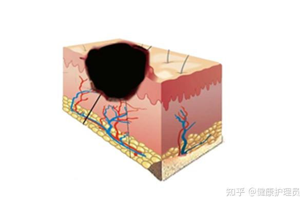 伤口结痂了但是周围红肿是什么情况? - 知乎