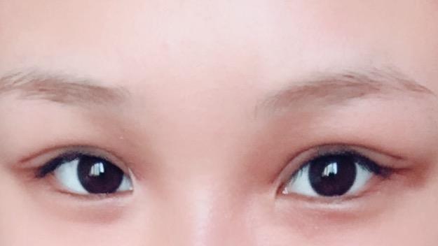 埋线双眼皮真实图 v2-44f9880a1dc6c77ac8a298a61bf213f2_r.jpg