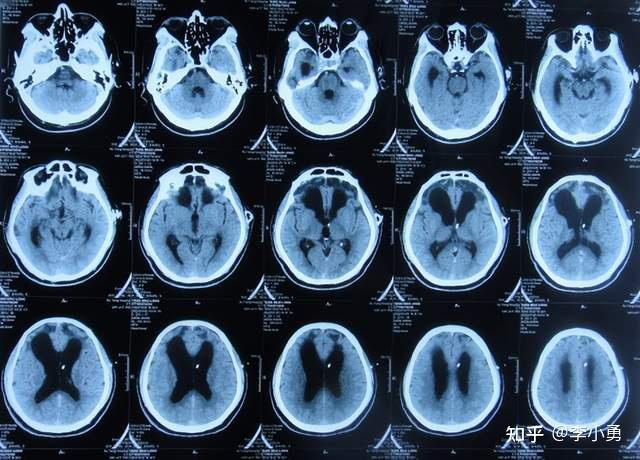 脑外伤后脑积水内镜三脑室造瘘术和脑积水分流术后仍脑积水意识差不能