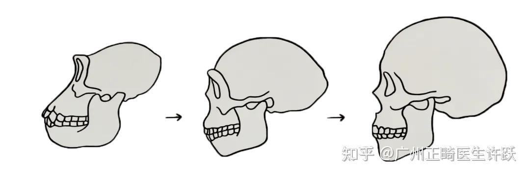 牙齿拥挤还嘴凸?儿童扩弓:牙性 vs 骨性怎么选? - 知乎