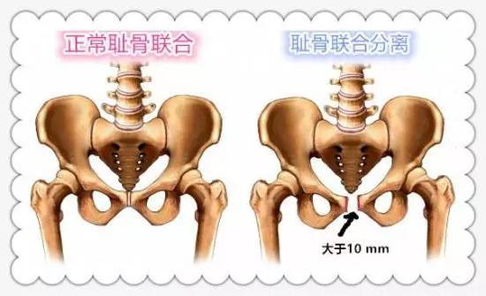 那个生完孩子瘫了的我是怎样熬过来 产后有一种痛叫耻骨联合分离 知乎