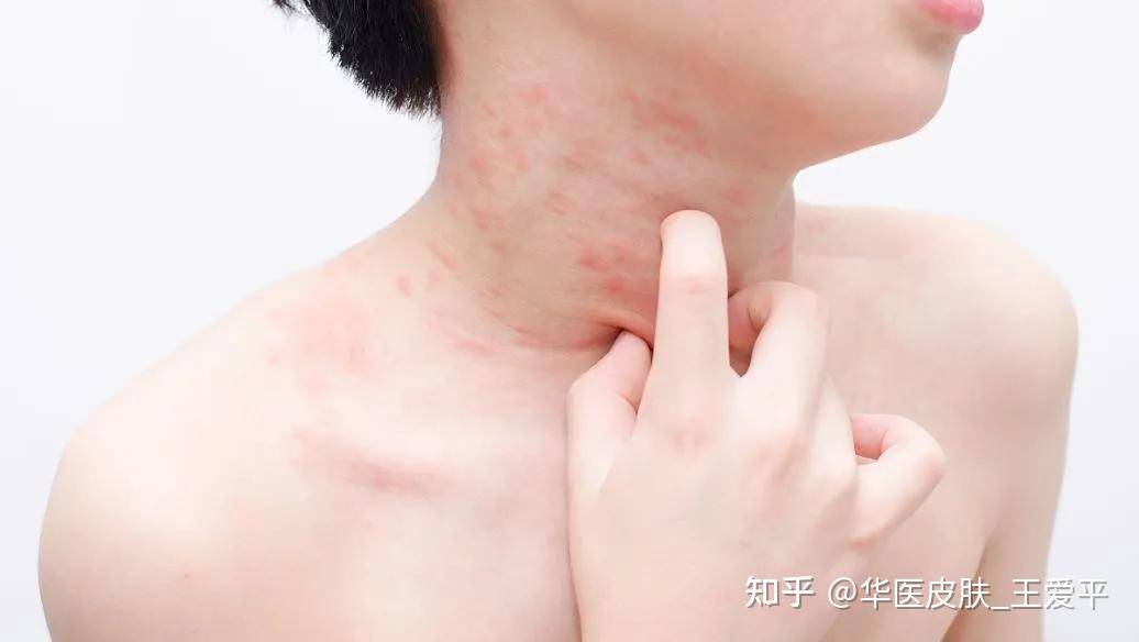 皮肤过敏症状有哪些反应?如何正确对待皮肤过敏 - 知乎