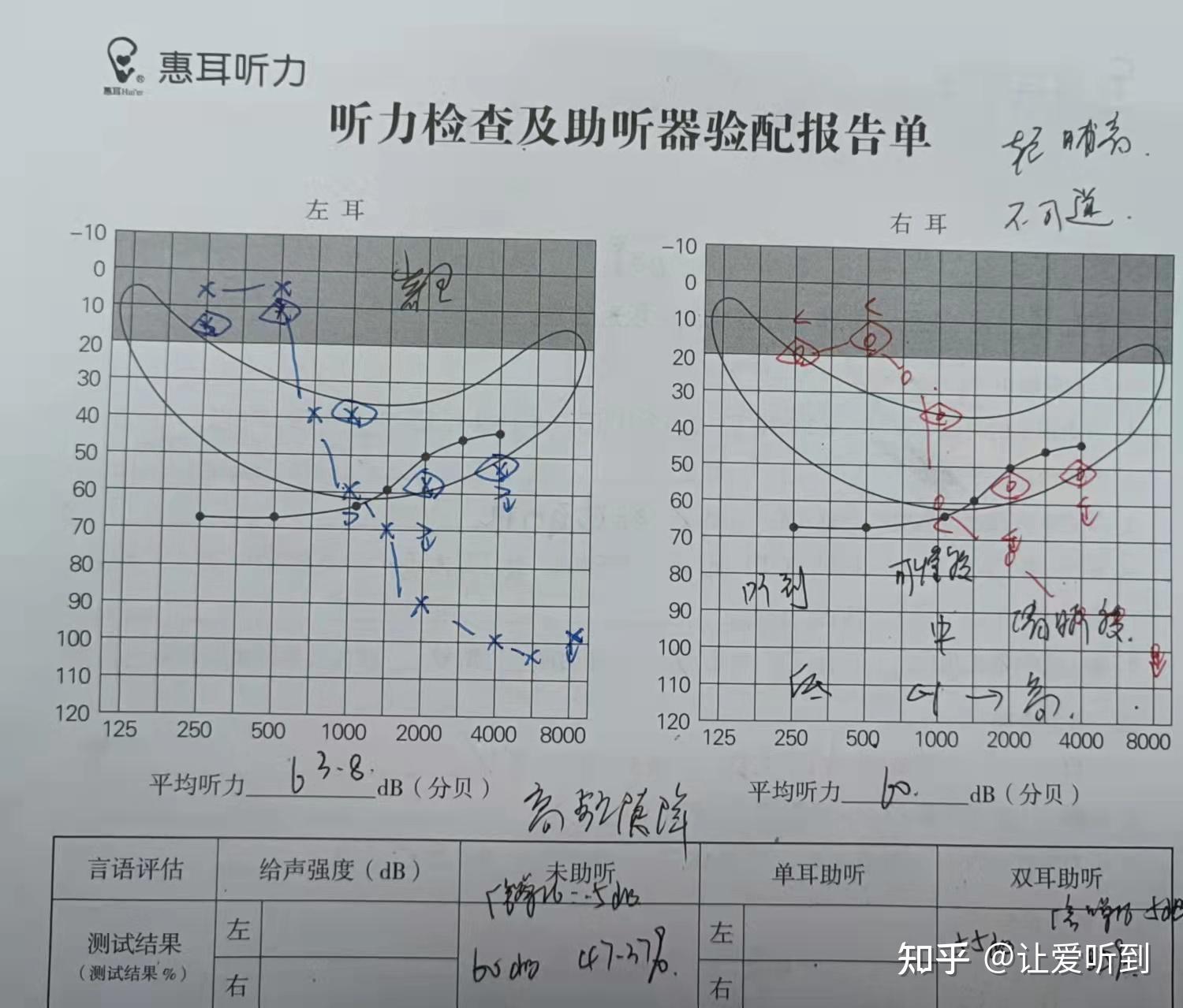重庆渝北助听器：高频陡降型听损干预指南！ - 知乎