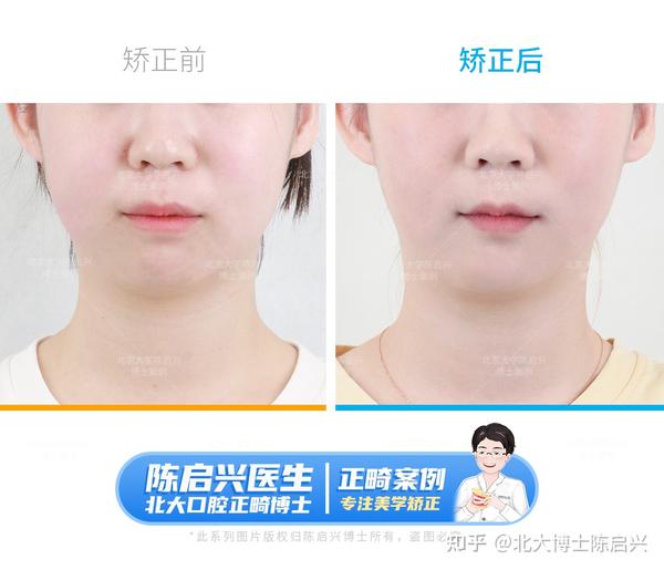 舌侧矫正改善骨性嘴凸+深覆合+露龈笑案例 - 知乎