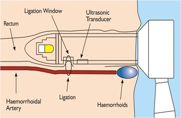 超声多普勒痔动脉结扎术痔疮治疗迈入无痛新时代