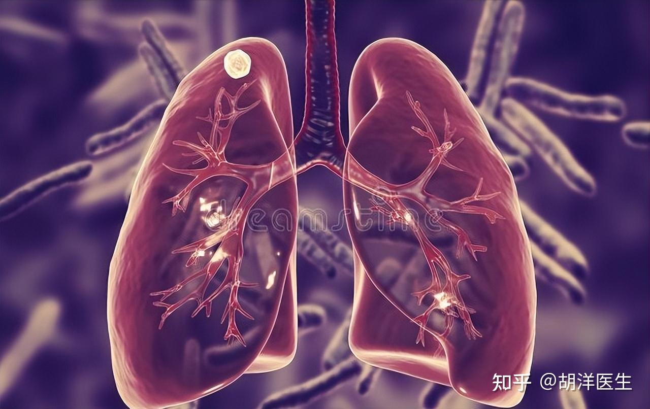 尤其是高危人群要定期复查ct,一旦发现,左晖和宗庆后属于第二种情况