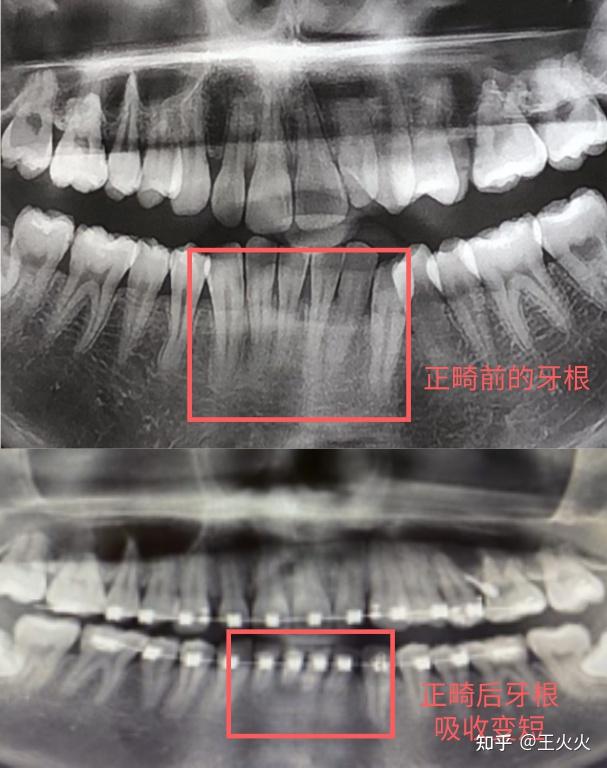 简单来说,正畸过程就是:牙齿受到力——传递给牙槽骨——牙槽骨吸收和