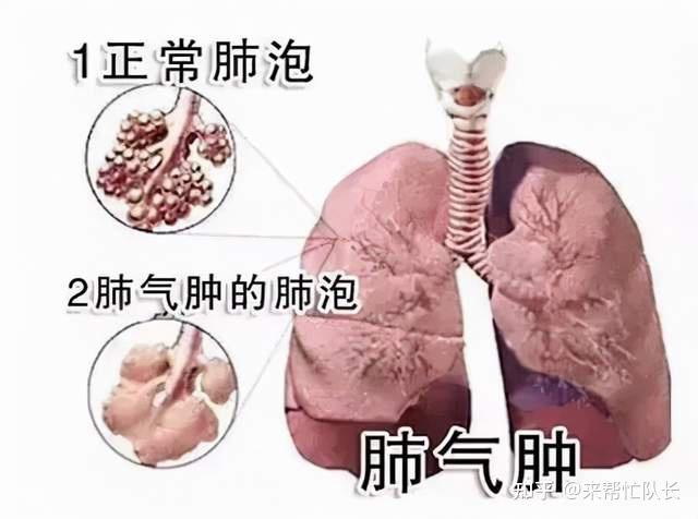 肺气肿的症状图片