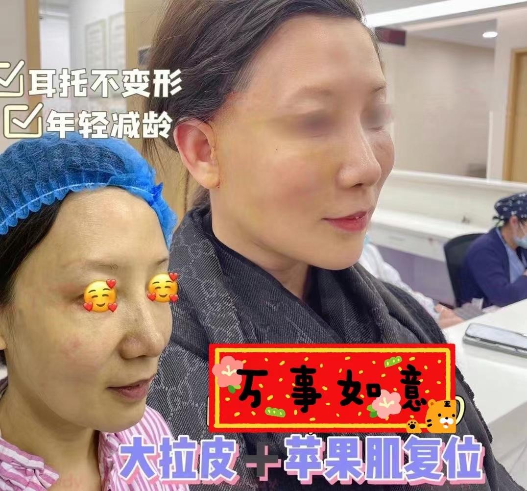 2022年上海面部拉皮手术专家是谁？ - 美妆技巧 - 整形医院排行榜