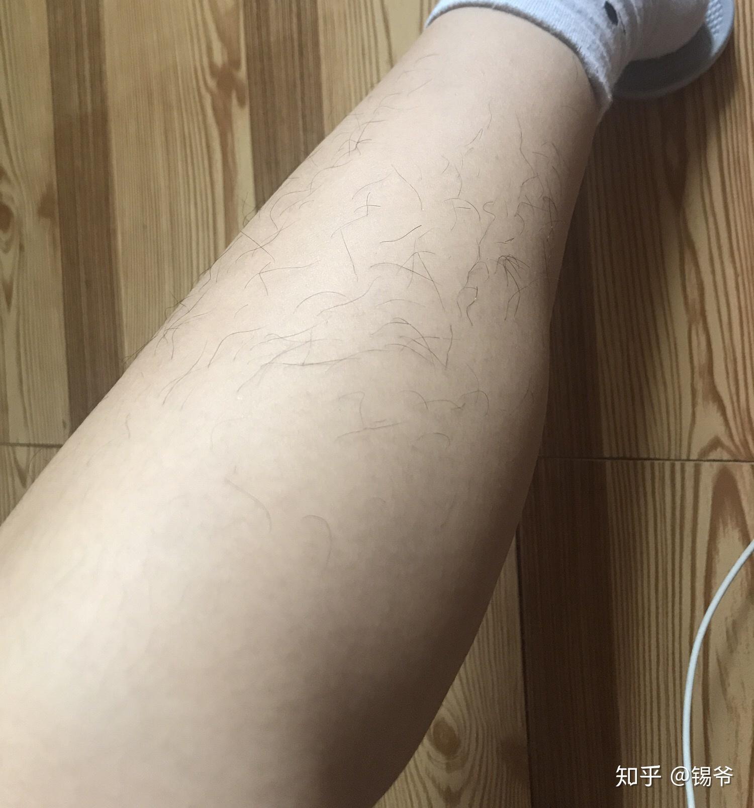 女生有腿毛怎么办