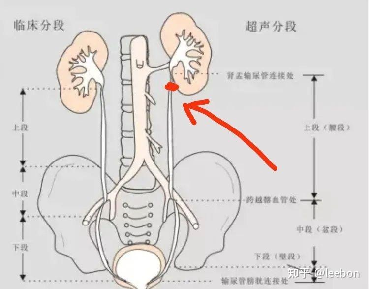 男性输尿管三个狭窄图片