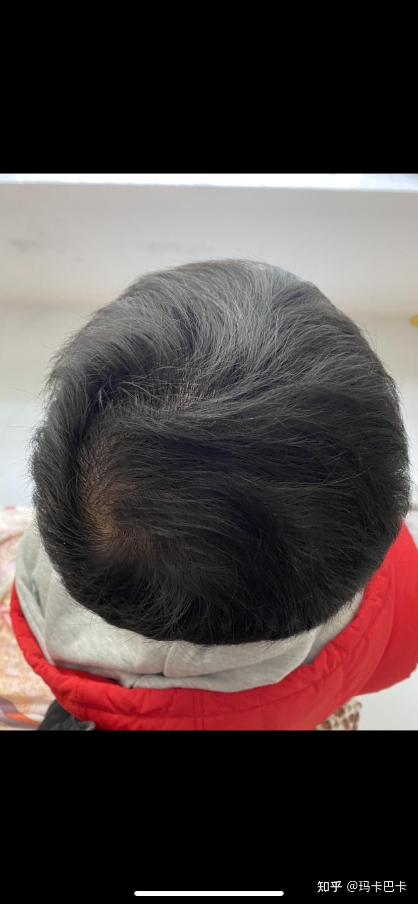 00后脱发记 - 知乎